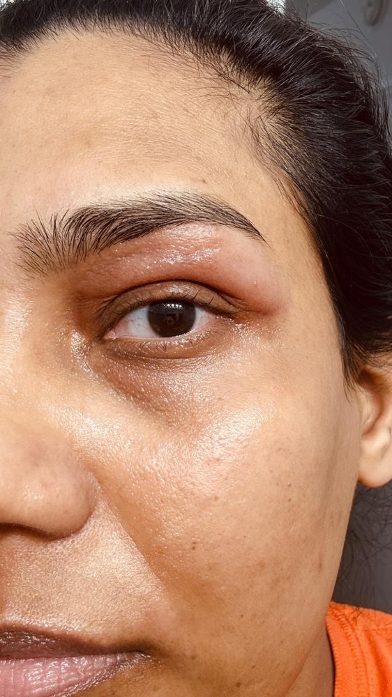 Customer photo accompanying Shradha T.'s Medicube mask review